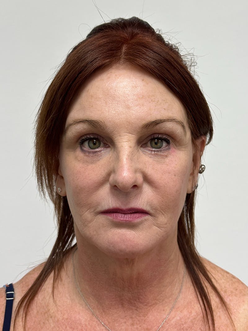 Facelift Before & After Gallery - Patient 149050082 - Image 2