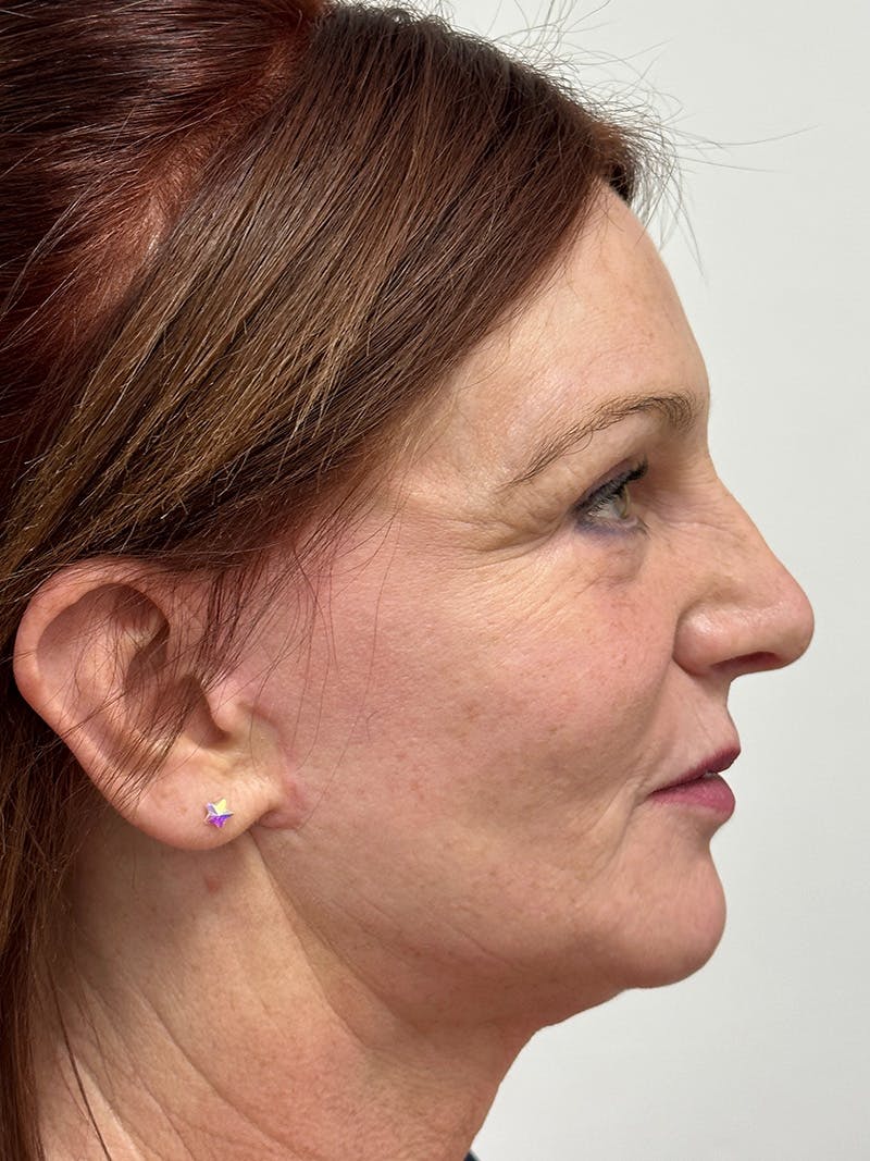 Facelift Before & After Gallery - Patient 149050082 - Image 6