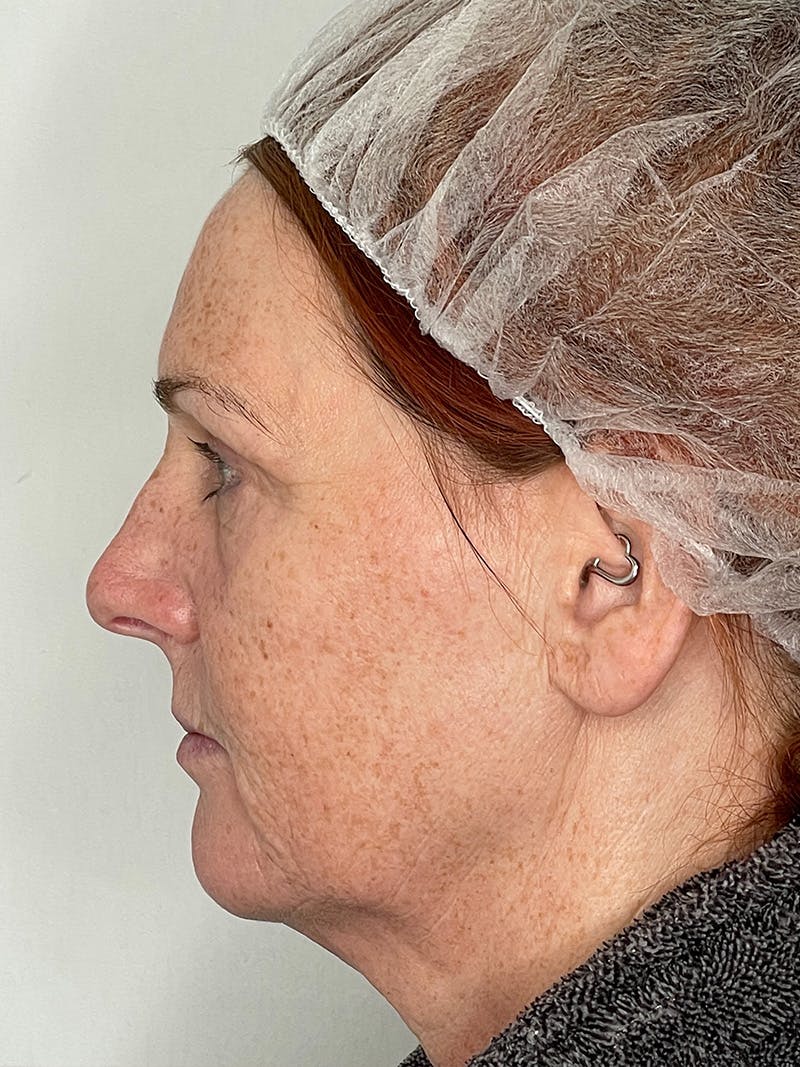 Facelift Before & After Gallery - Patient 149050082 - Image 7