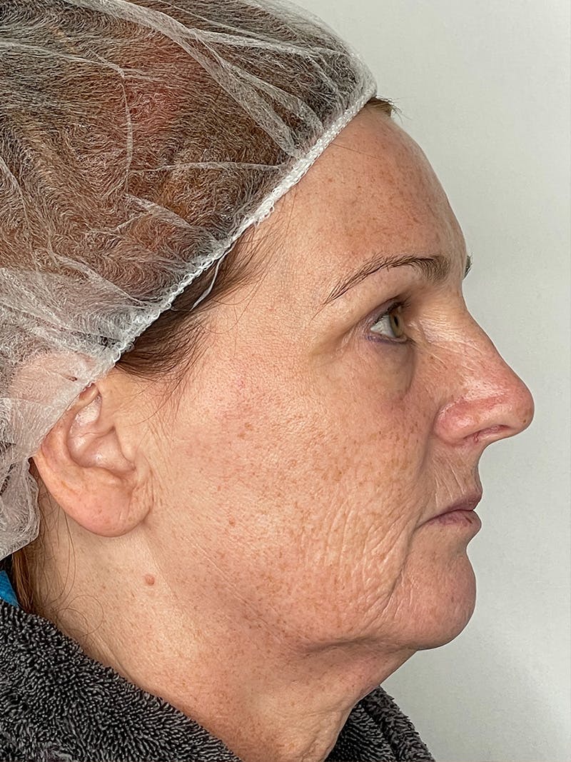 Facelift Before & After Gallery - Patient 149050082 - Image 5