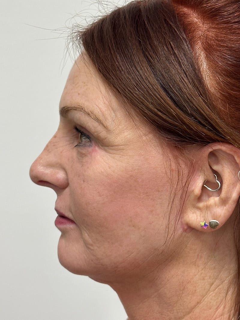 Facelift Before & After Gallery - Patient 149050082 - Image 8