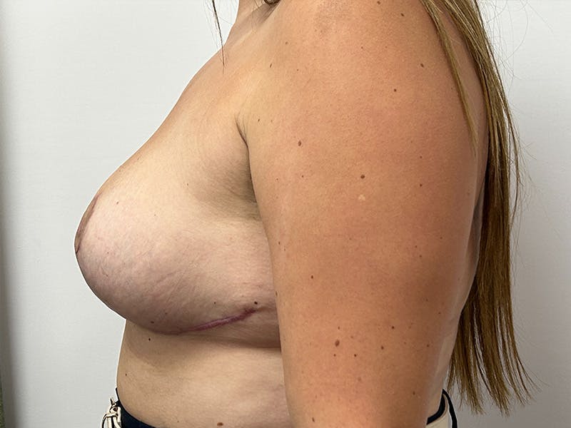 Breast Uplift Before & After Gallery - Patient 149050079 - Image 10