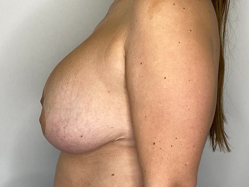 Breast Uplift Before & After Gallery - Patient 149050079 - Image 9