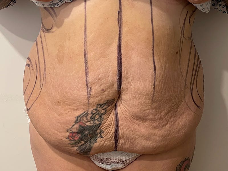 Tummy Tuck Before & After Gallery - Patient 149050060 - Image 1