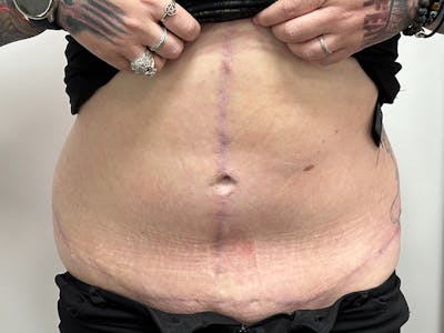 Tummy Tuck Before & After Gallery - Patient 149050060 - Image 2