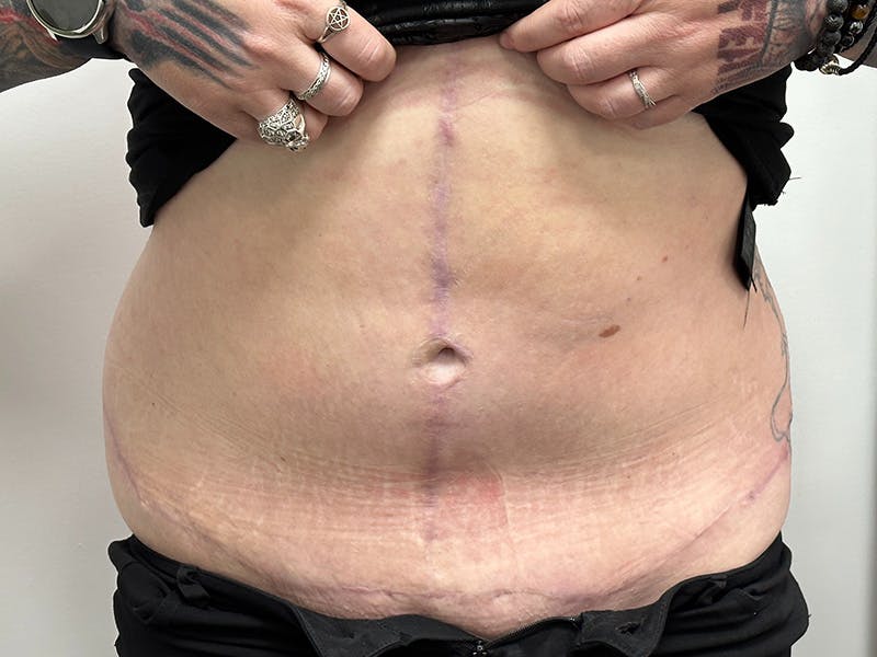 Tummy Tuck Before & After Gallery - Patient 149050060 - Image 2