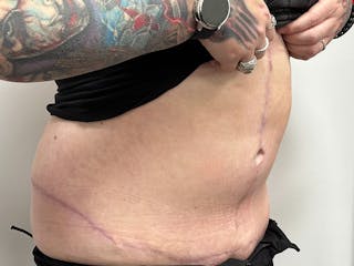 Tummy Tuck Before & After Gallery - Patient 149050060 - Image 4