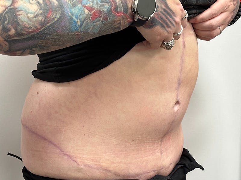 Tummy Tuck Before & After Gallery - Patient 149050060 - Image 4