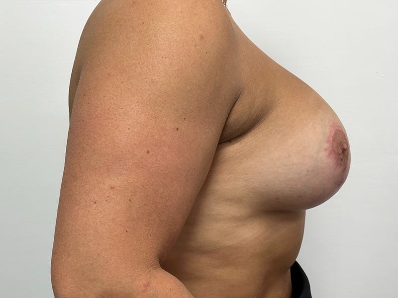 Breast Uplift with Implants Before & After Gallery - Patient 149050076 - Image 6