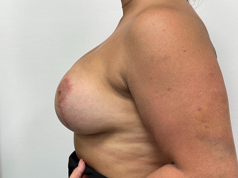 Breast Uplift with Implants Before & After Gallery - Patient 149050076 - Image 10