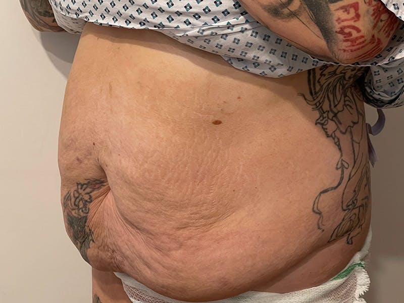 Tummy Tuck Before & After Gallery - Patient 149050060 - Image 7