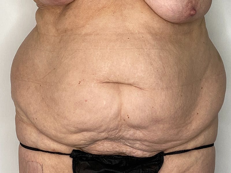 Tummy Tuck Before & After Gallery - Patient 149050063 - Image 1