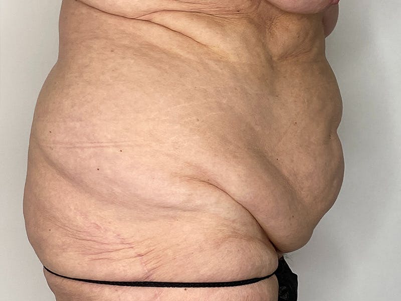 Tummy Tuck Before & After Gallery - Patient 149050063 - Image 3