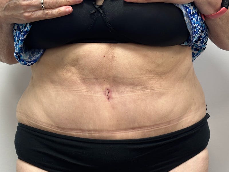 Tummy Tuck Before & After Gallery - Patient 149050063 - Image 2