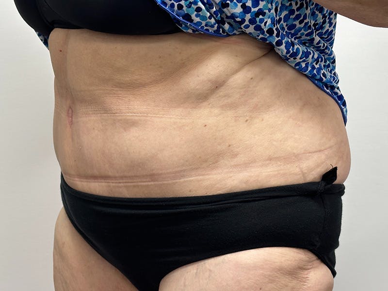 Tummy Tuck Before & After Gallery - Patient 149050063 - Image 6