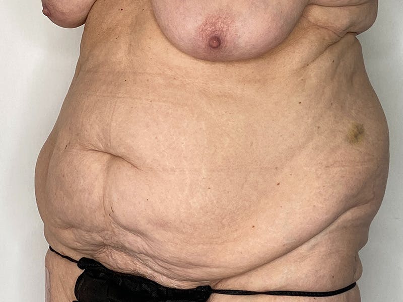 Tummy Tuck Before & After Gallery - Patient 149050063 - Image 5