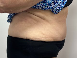Tummy Tuck Before & After Gallery - Patient 149050063 - Image 4