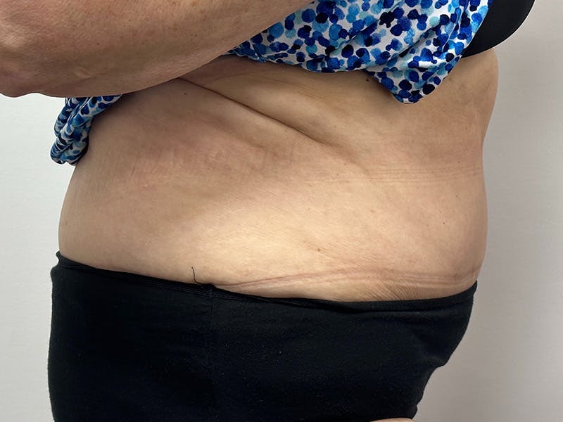 Tummy Tuck Before & After Gallery - Patient 149050063 - Image 4