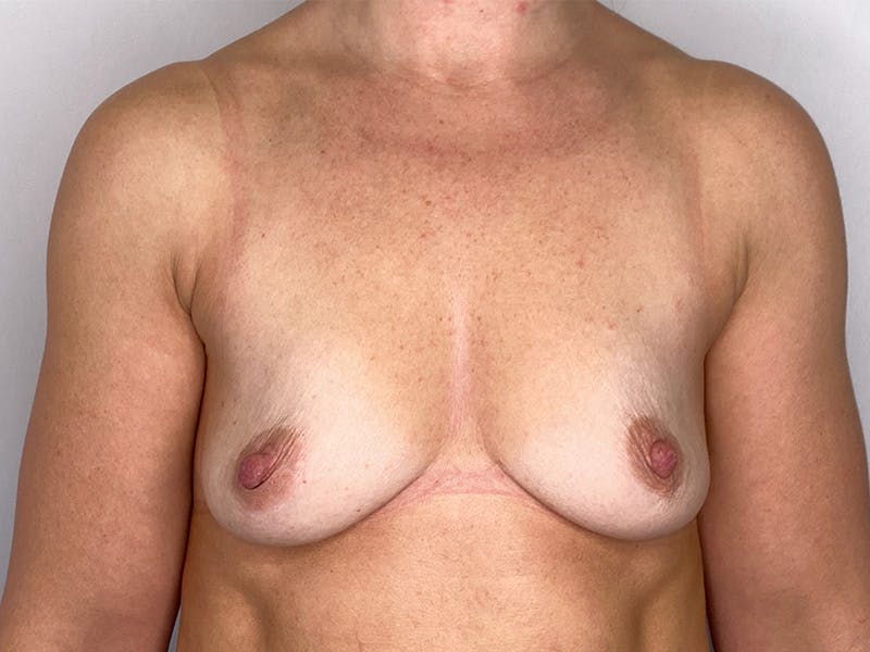 Breast Augmentation Before & After Gallery - Patient 149050070 - Image 1