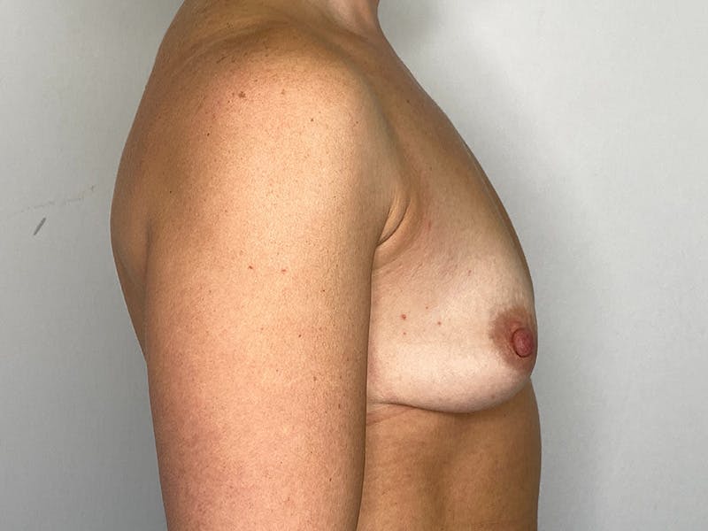 Breast Augmentation Before & After Gallery - Patient 149050070 - Image 5