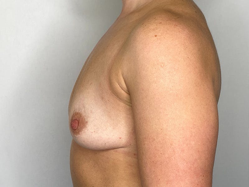 Breast Augmentation Before & After Gallery - Patient 149050070 - Image 9