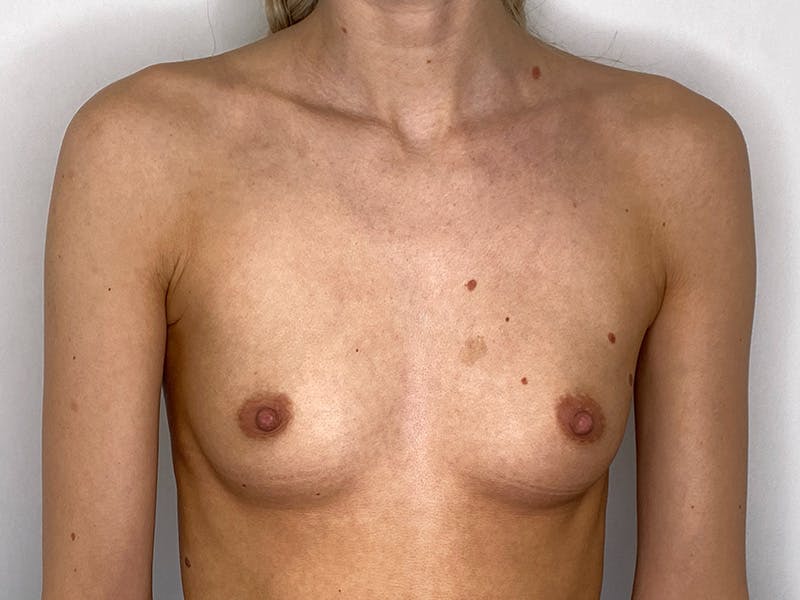 Breast Augmentation Before & After Gallery - Patient 149050069 - Image 1