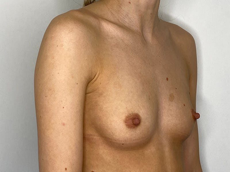Breast Augmentation Before & After Gallery - Patient 149050069 - Image 3
