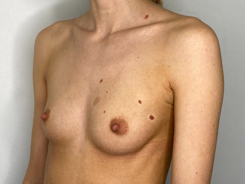 Breast Augmentation Before & After Gallery - Patient 149050069 - Image 7
