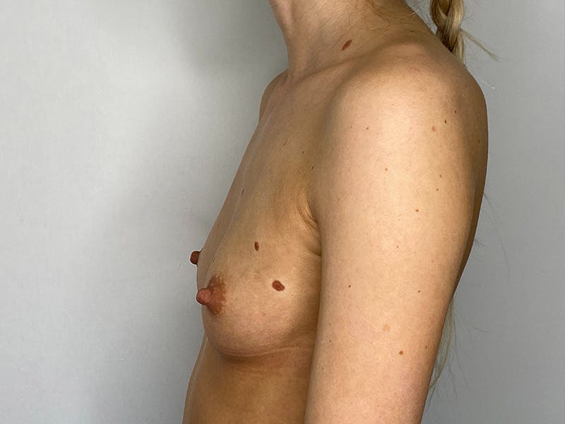 Breast Augmentation Before & After Gallery - Patient 149050069 - Image 9