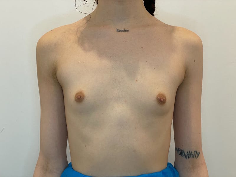 Breast Augmentation Before & After Gallery - Patient 135104 - Image 1