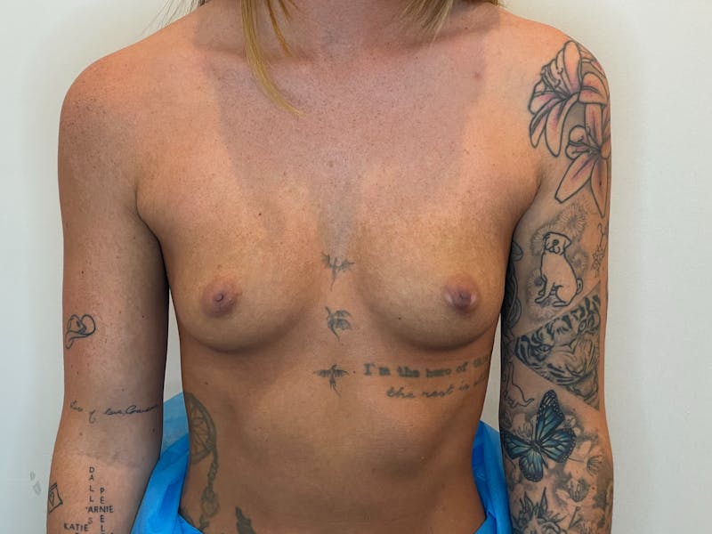 Breast Augmentation Before & After Gallery - Patient 283170 - Image 1