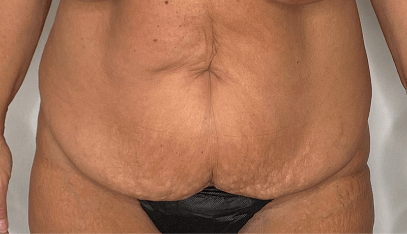 Tummy Tuck Before & After Gallery - Patient 141597235 - Image 1