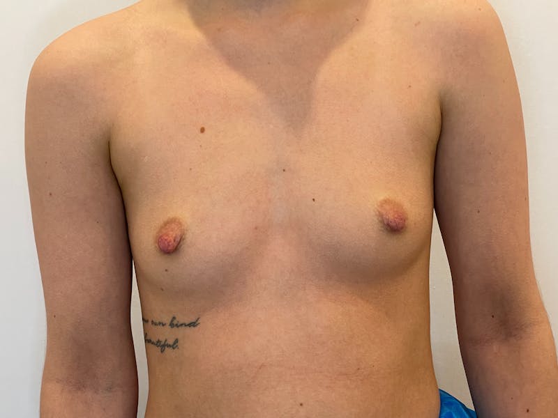 Breast Augmentation Before & After Gallery - Patient 170238 - Image 1