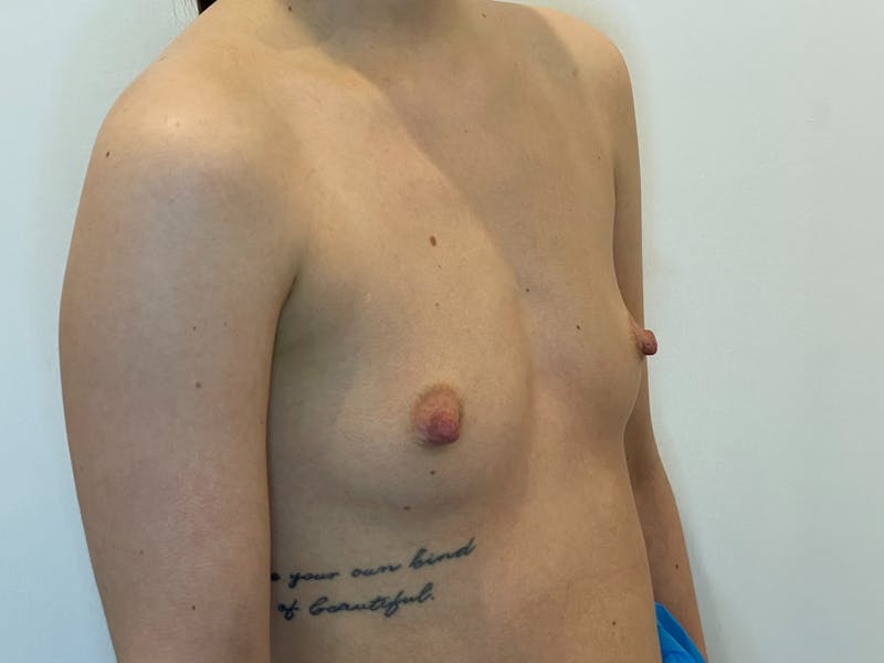 Breast Augmentation Before & After Gallery - Patient 170238 - Image 3