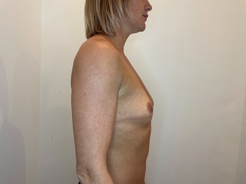 Breast Augmentation Before & After Gallery - Patient 541218 - Image 3