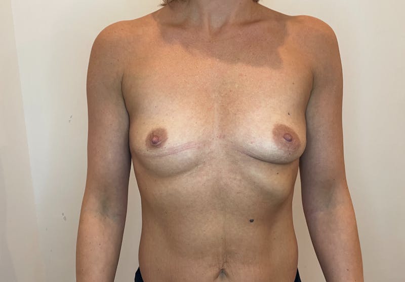 Breast Augmentation Before & After Gallery - Patient 541218 - Image 1