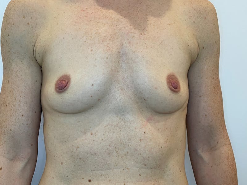 Breast Augmentation Before & After Gallery - Patient 128427 - Image 1