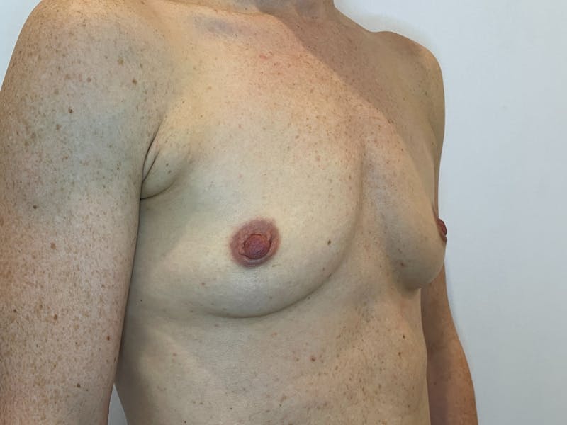 Breast Augmentation Before & After Gallery - Patient 128427 - Image 3