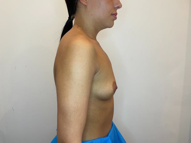 Breast Augmentation Before & After Gallery - Patient 356738 - Image 3