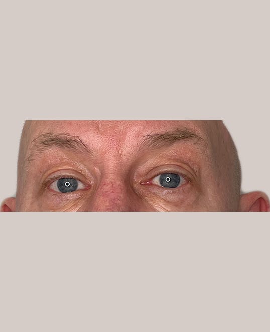 Eyelid Surgery