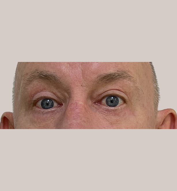 Eyelid Surgery