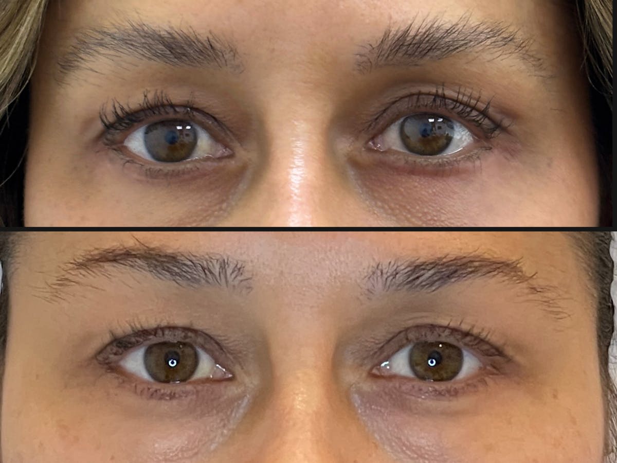 Eyelid Surgery Before & After Gallery - Patient 178540 - Image 1