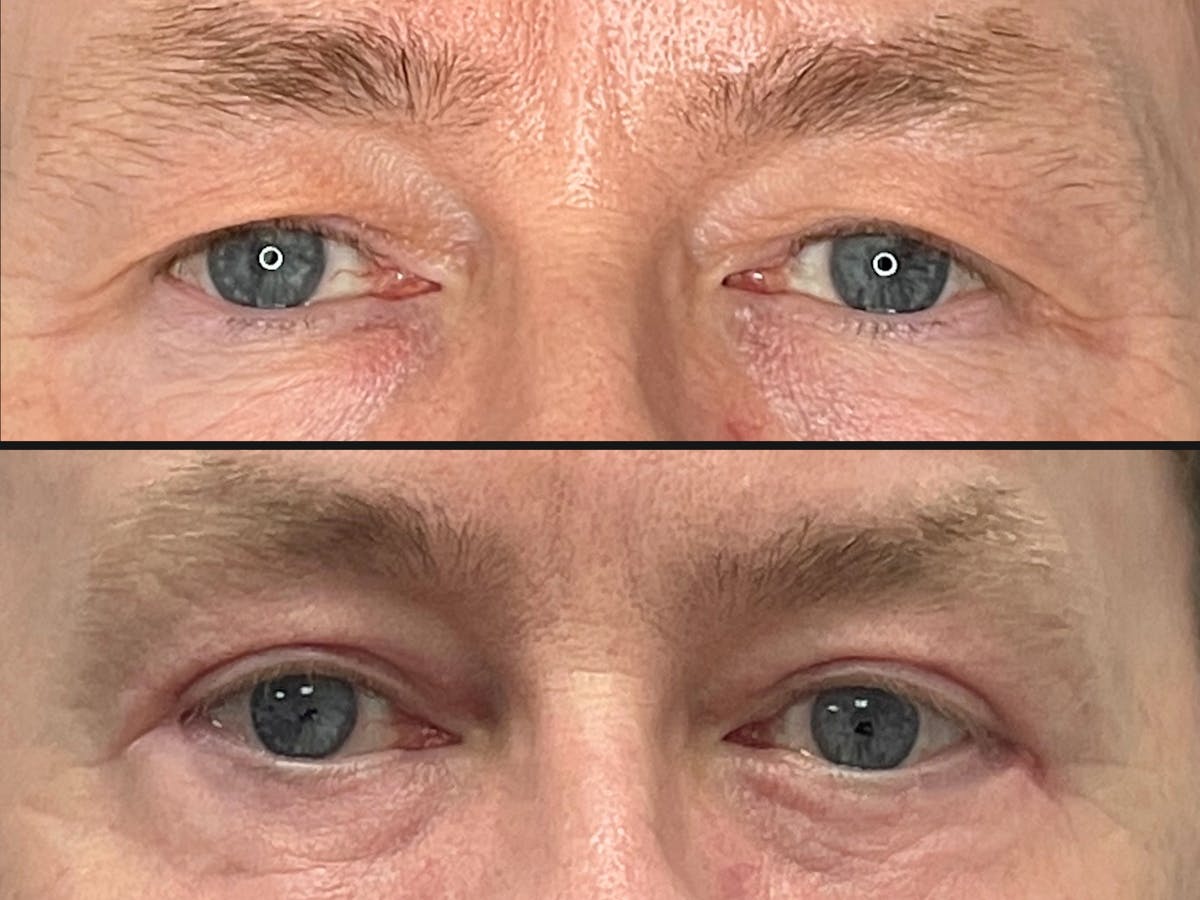 Eyelid Surgery Before & After Gallery - Patient 277974 - Image 1
