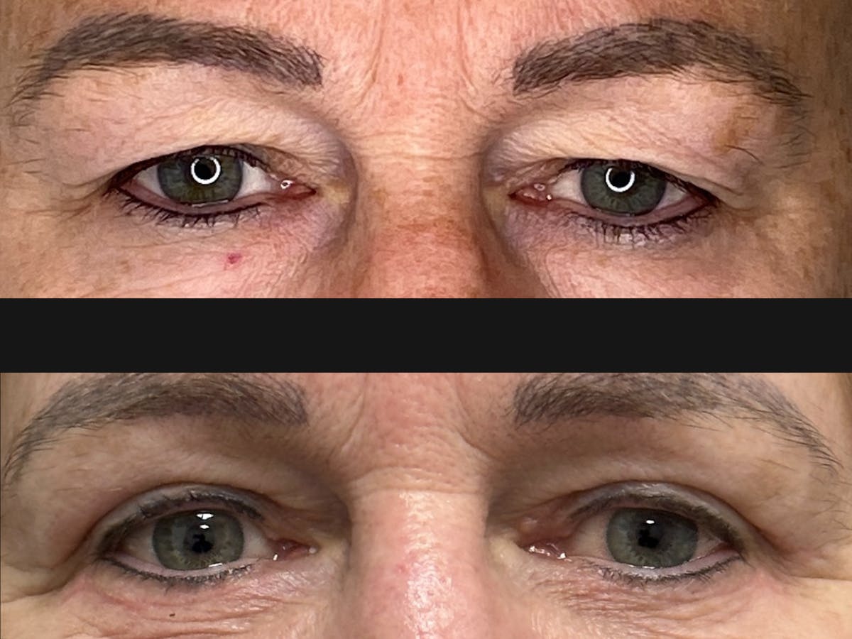 Eyelid Surgery Before & After Gallery - Patient 122866 - Image 1