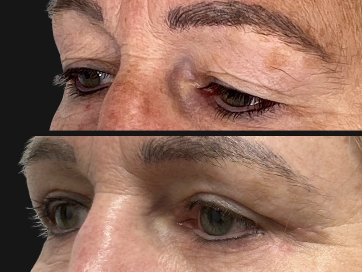 Eyelid Surgery Before & After Gallery - Patient 122866 - Image 2