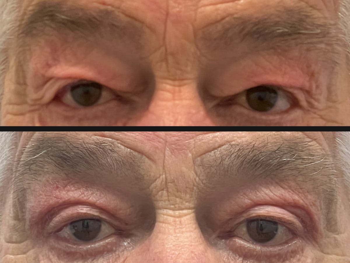 Eyelid Surgery Before & After Gallery - Patient 102648 - Image 1