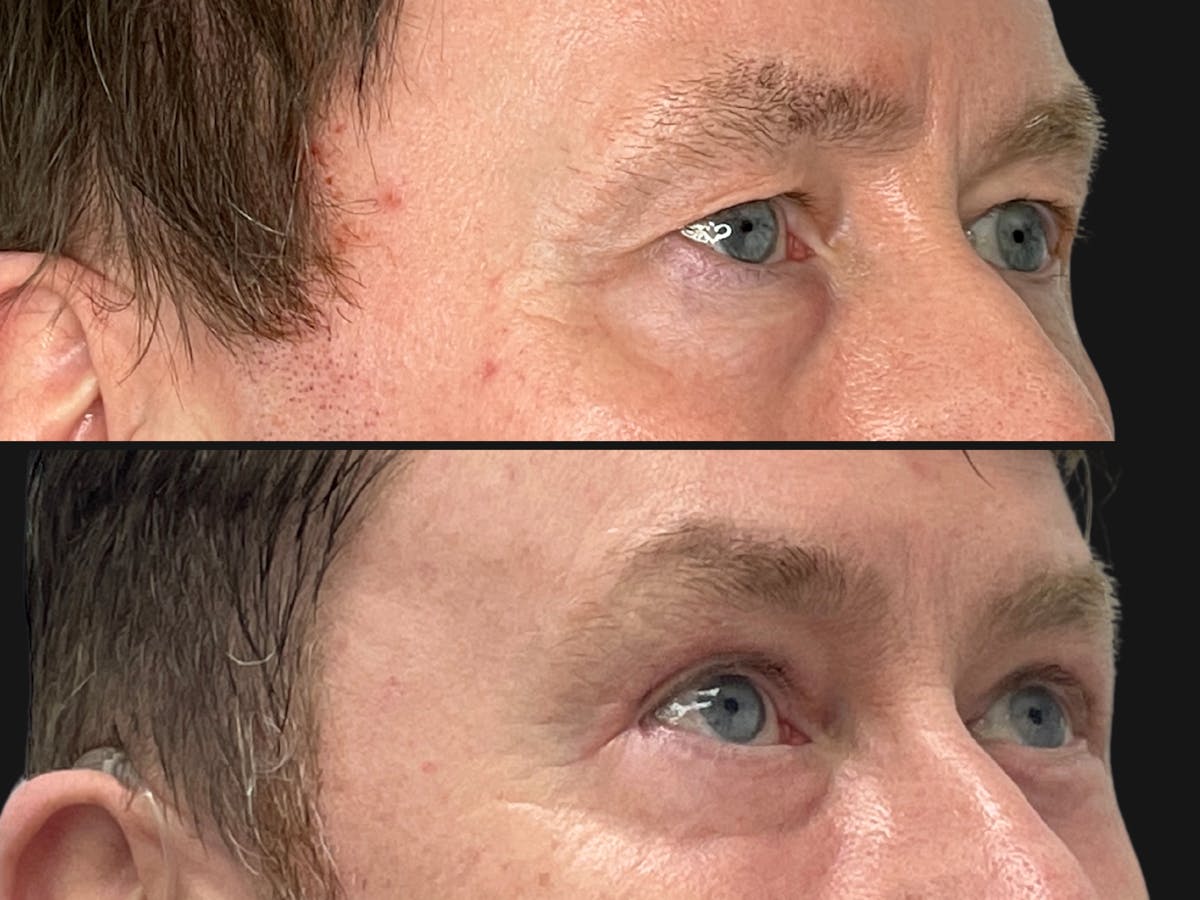 Eyelid Surgery Before & After Gallery - Patient 277974 - Image 2