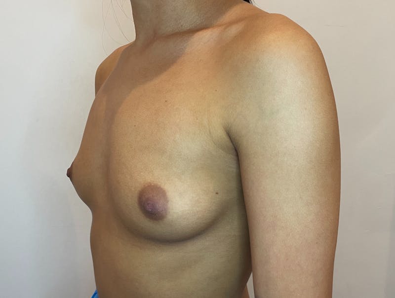 Breast Augmentation Before & After Gallery - Patient 356738 - Image 7