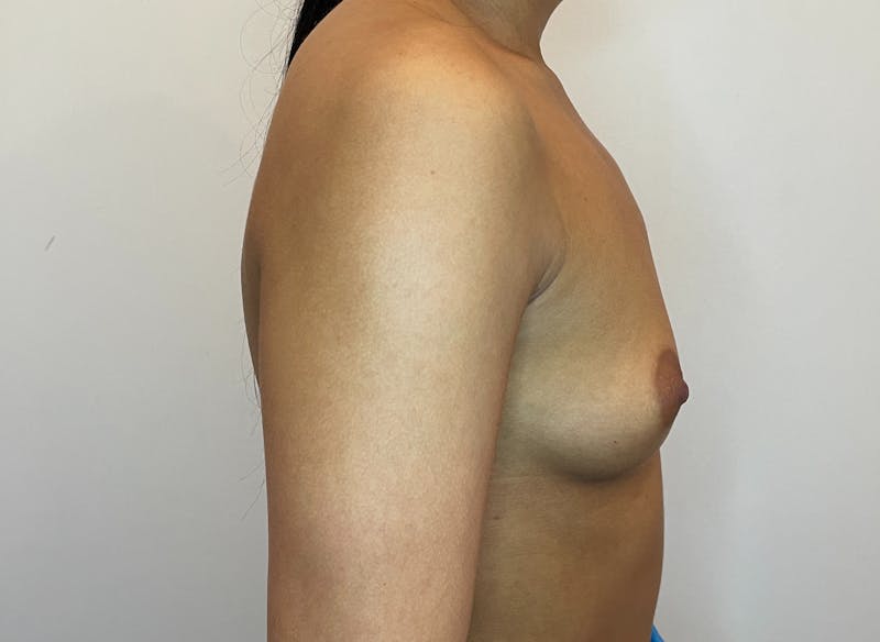 Breast Augmentation Before & After Gallery - Patient 356738 - Image 3