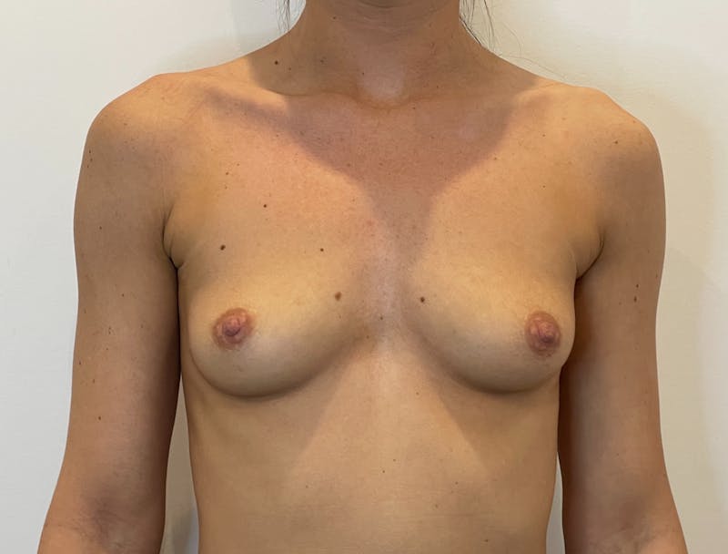 Breast Augmentation Before & After Gallery - Patient 815657 - Image 1